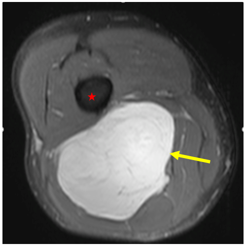 Liposarcoma